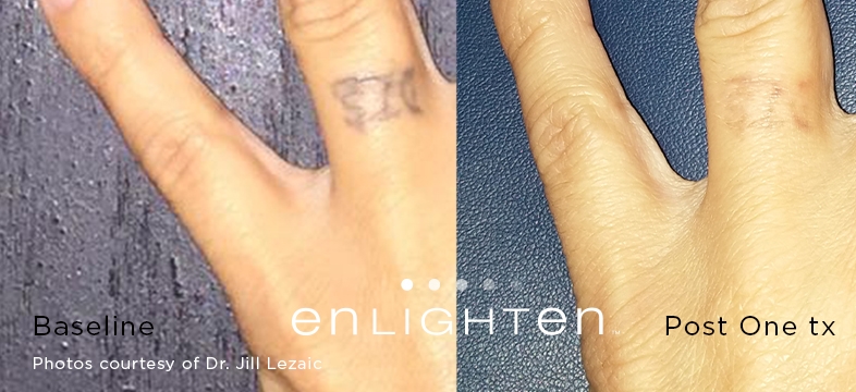 Laserowe usuwanie małego tatuażu- przed i po