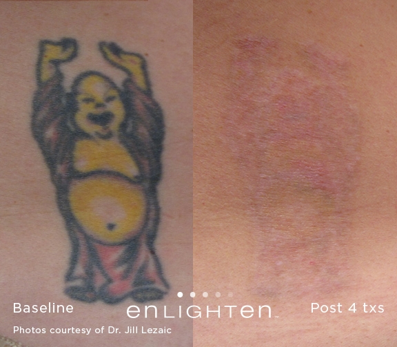 laserowe usuwanie tatuażu efekty przed i po zabiegu